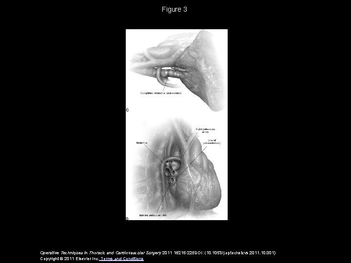 Figure 3 Operative Techniques in Thoracic and Cardiovascular Surgery 2011 16215 -225 DOI: (10.