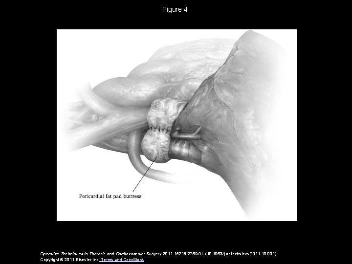 Figure 4 Operative Techniques in Thoracic and Cardiovascular Surgery 2011 16215 -225 DOI: (10.