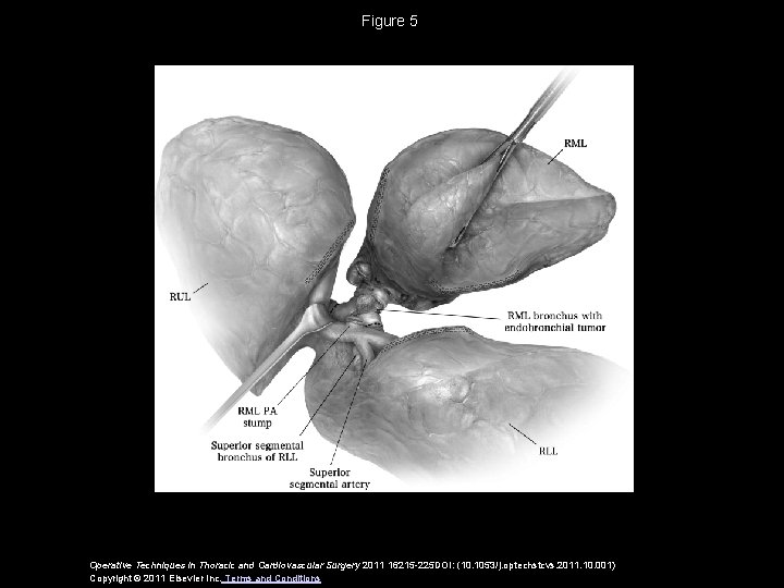 Figure 5 Operative Techniques in Thoracic and Cardiovascular Surgery 2011 16215 -225 DOI: (10.