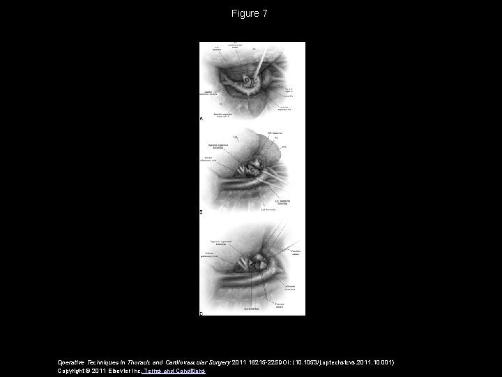 Figure 7 Operative Techniques in Thoracic and Cardiovascular Surgery 2011 16215 -225 DOI: (10.