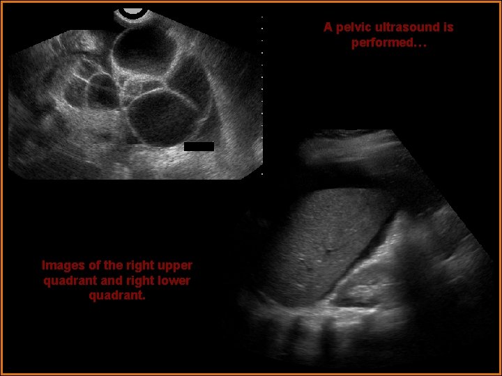 A pelvic ultrasound is performed… Images of the right upper quadrant and right lower