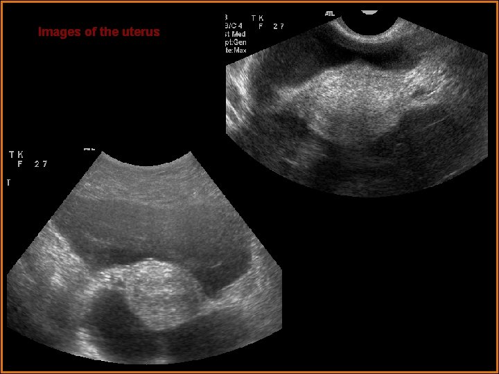 Images of the uterus 