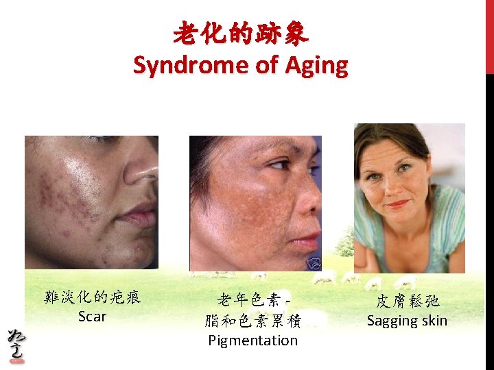 老化的跡象 Syndrome of Aging 難淡化的疤痕 Scar 老年色素 脂和色素累積 Pigmentation 皮膚鬆弛 Sagging skin 老化的跡象 Syndrome of Aging 難淡化的疤痕 Scar 老年色素 脂和色素累積 Pigmentation 皮膚鬆弛 Sagging skin