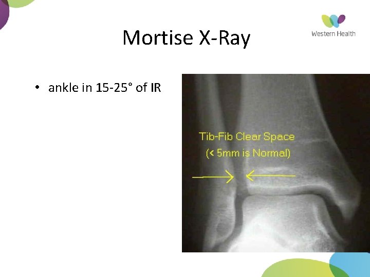 Mortise X-Ray • ankle in 15 -25° of IR 