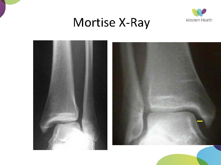 Mortise X-Ray 