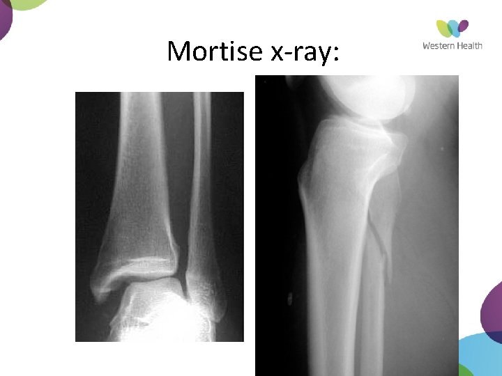 Mortise x-ray: 