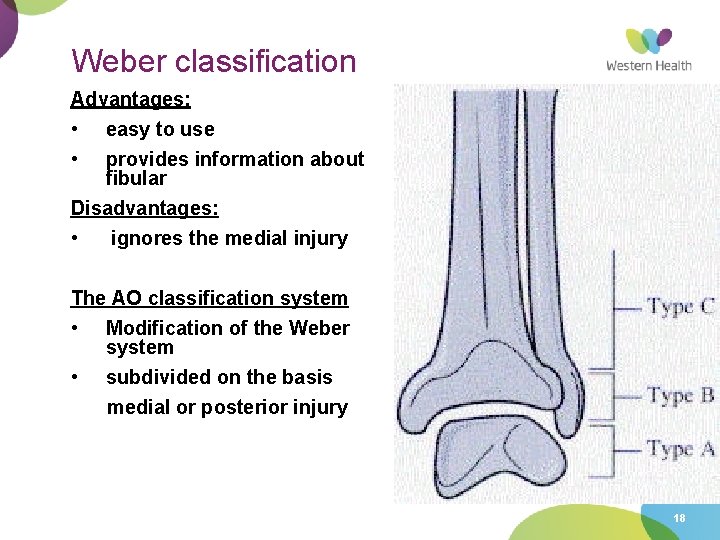 Weber classification Advantages: • easy to use • provides information about fibular Disadvantages: •