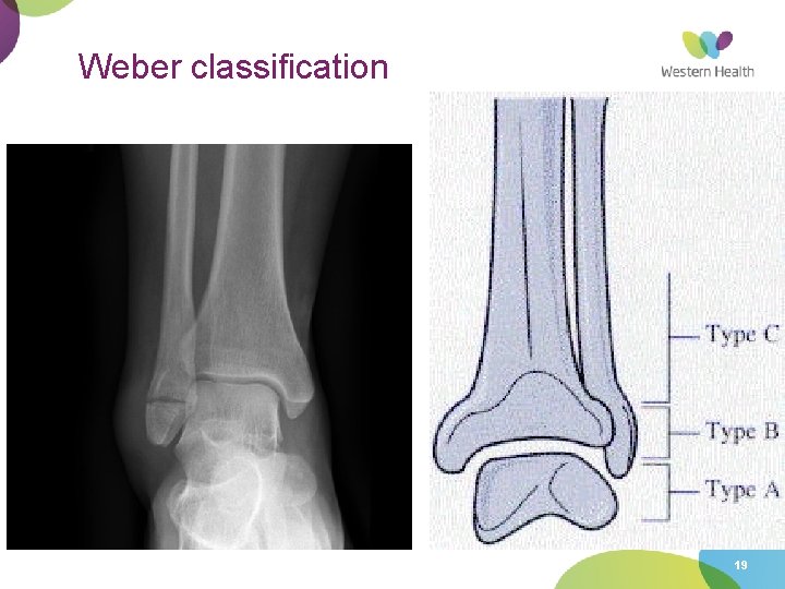 Weber classification 19 