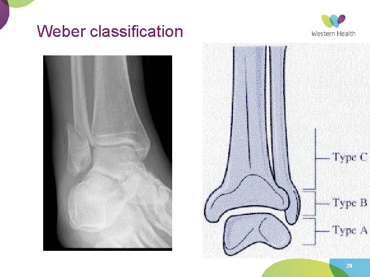 Weber classification 20 