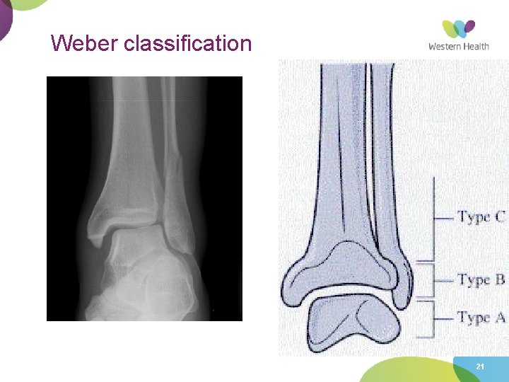 Weber classification 21 