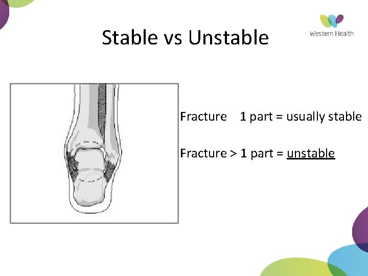 Stable vs Unstable • Fracture 1 part = usually stable • Fracture > 1