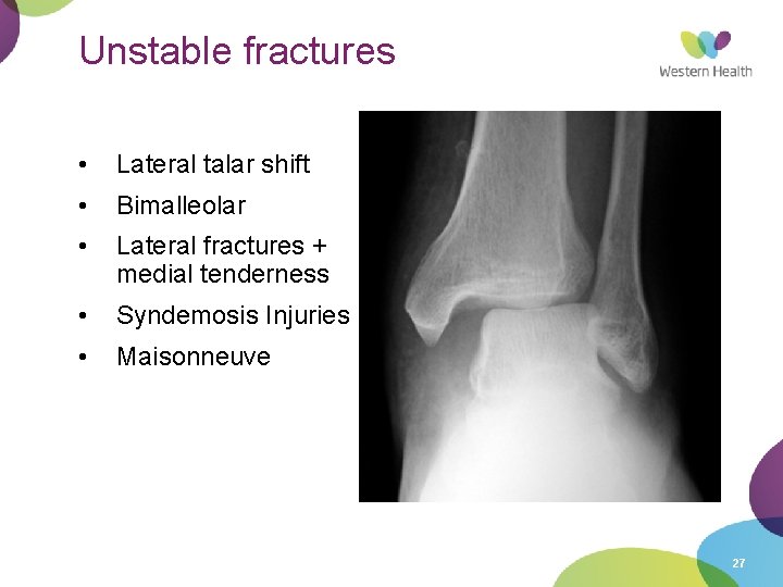 Unstable fractures • Lateral talar shift • Bimalleolar • Lateral fractures + medial tenderness