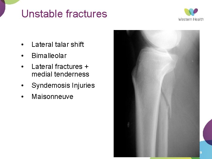 Unstable fractures • Lateral talar shift • Bimalleolar • Lateral fractures + medial tenderness