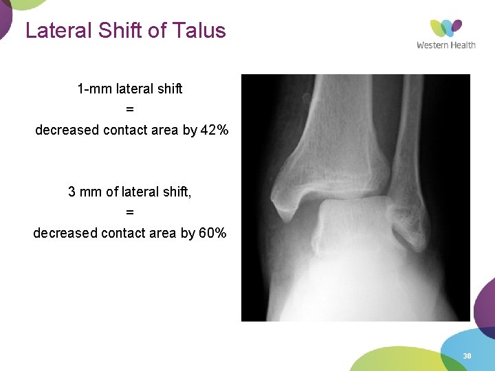 Lateral Shift of Talus 1 -mm lateral shift = decreased contact area by 42%