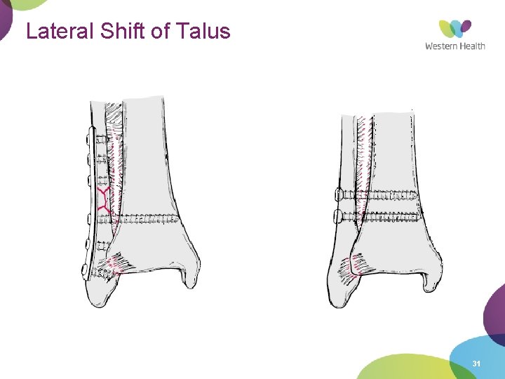 Lateral Shift of Talus 31 