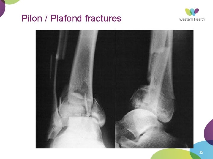 Pilon / Plafond fractures 32 