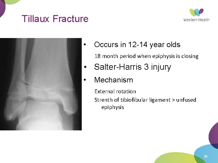 Tillaux Fracture • Occurs in 12 -14 year olds 18 month period when epiphysis