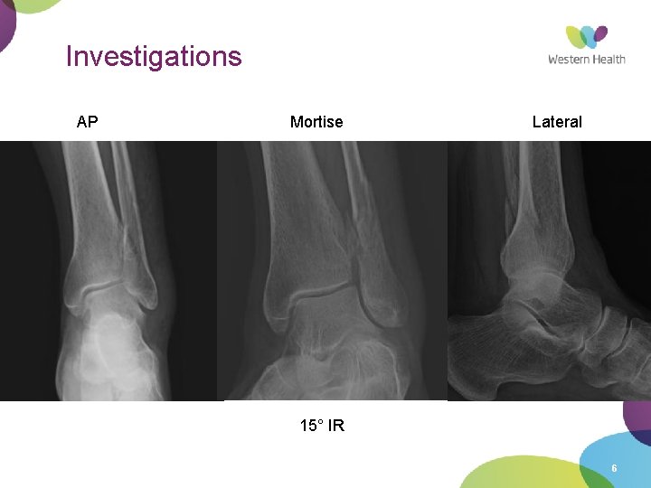 Investigations AP Mortise Lateral 15° IR 6 