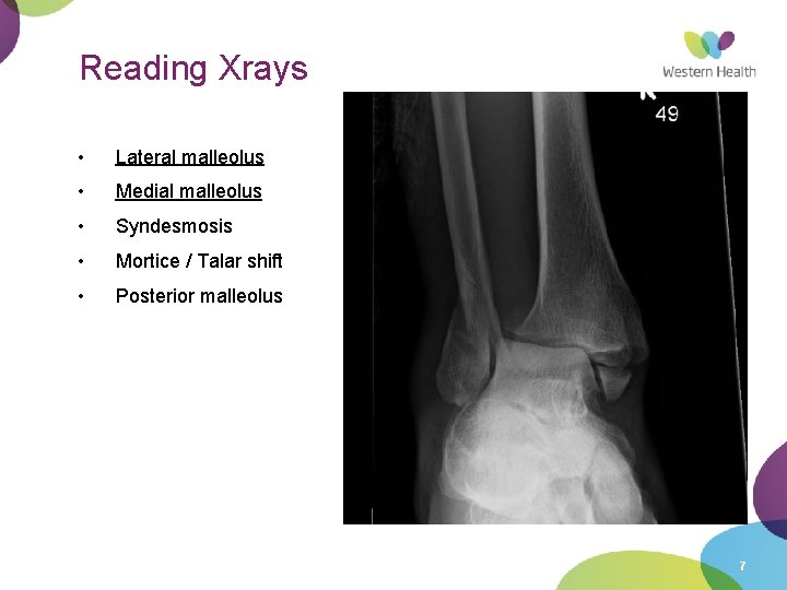 Reading Xrays • Lateral malleolus • Medial malleolus • Syndesmosis • Mortice / Talar