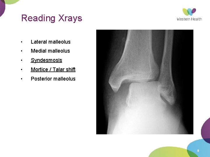 Reading Xrays • Lateral malleolus • Medial malleolus • Syndesmosis • Mortice / Talar