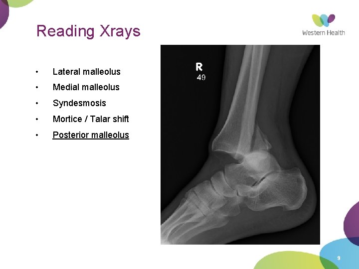 Reading Xrays • Lateral malleolus • Medial malleolus • Syndesmosis • Mortice / Talar