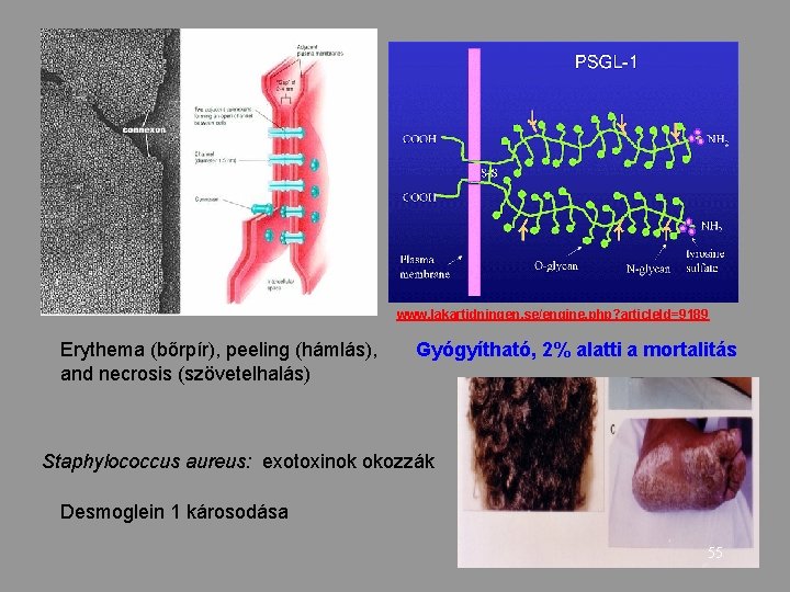 www. lakartidningen. se/engine. php? article. Id=9189 Erythema (bőrpír), peeling (hámlás), and necrosis (szövetelhalás) Gyógyítható,