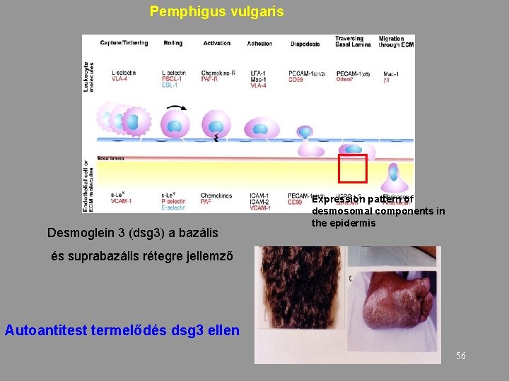 Pemphigus vulgaris Desmoglein 3 (dsg 3) a bazális Expression pattern of desmosomal components in