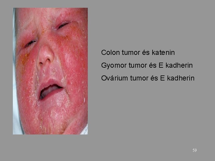 Colon tumor és katenin Gyomor tumor és E kadherin Ovárium tumor és E kadherin