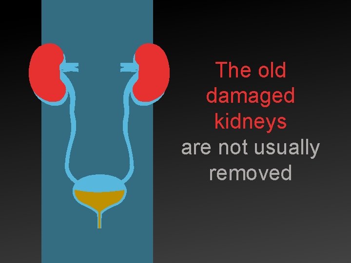 The old damaged kidneys are not usually removed 