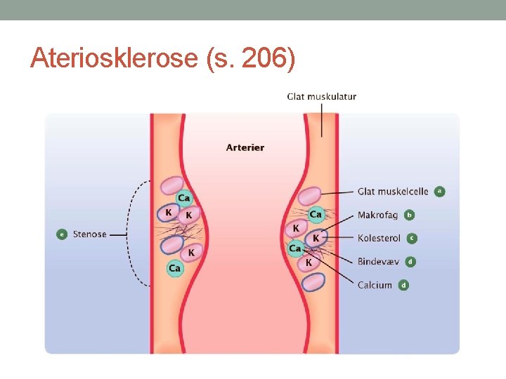 Ateriosklerose (s. 206) 