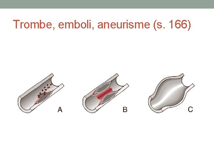 Trombe, emboli, aneurisme (s. 166) 
