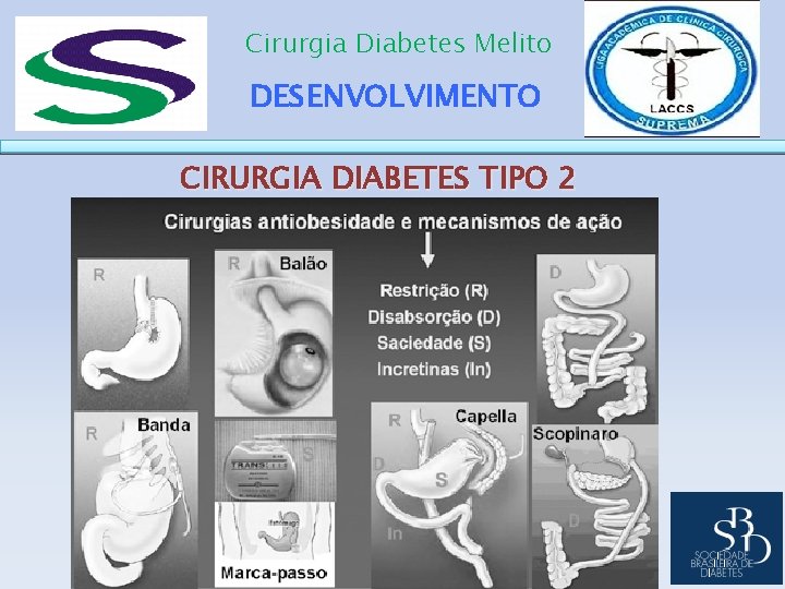 Cirurgia Diabetes Melito DESENVOLVIMENTO CIRURGIA DIABETES TIPO 2 