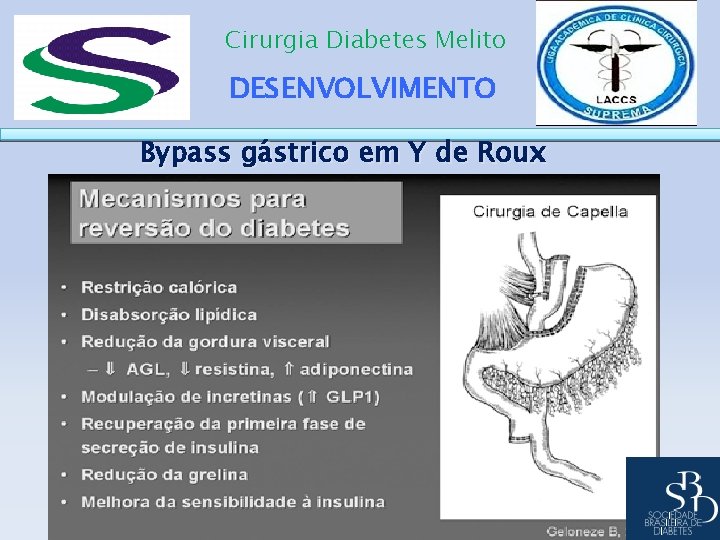 Cirurgia Diabetes Melito DESENVOLVIMENTO Bypass gástrico em Y de Roux 