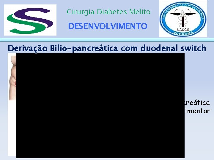 Cirurgia Diabetes Melito DESENVOLVIMENTO Derivação Bilio-pancreática com duodenal switch Alça bílio-pancreática de 100 cm