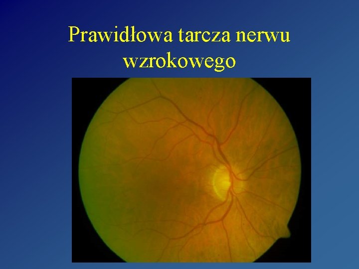 Prawidłowa tarcza nerwu wzrokowego Prawidłowa tarcza nerwu wzrokowego