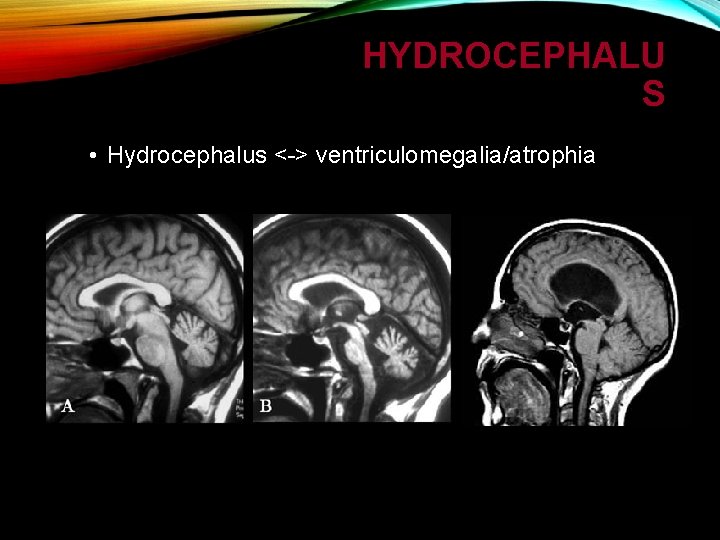 HYDROCEPHALU S • Hydrocephalus <-> ventriculomegalia/atrophia 