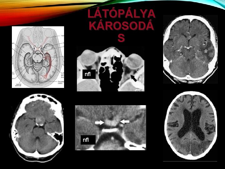 LÁTÓPÁLYA KÁROSODÁ S nf. I 