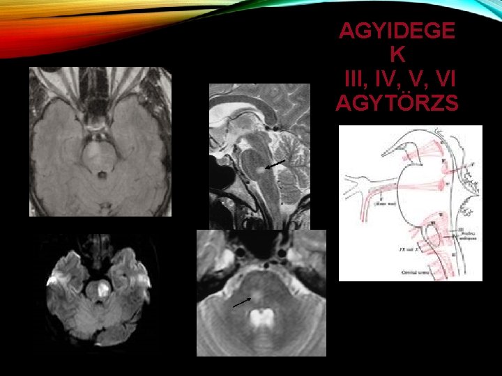 AGYIDEGE K III, IV, V, VI AGYTÖRZS 