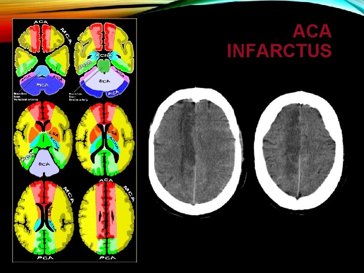 ACA INFARCTUS 