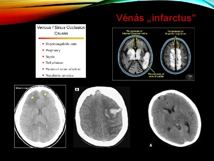 Vénás „infarctus” 