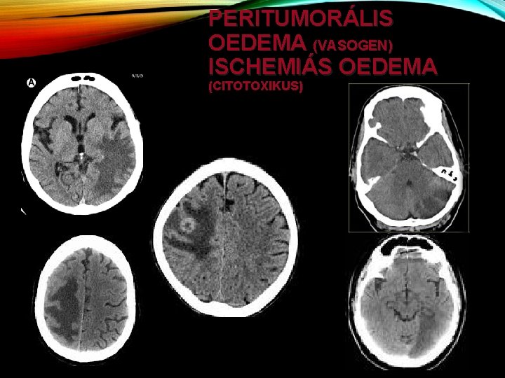 PERITUMORÁLIS OEDEMA (VASOGEN) ISCHEMIÁS OEDEMA (CITOTOXIKUS) 