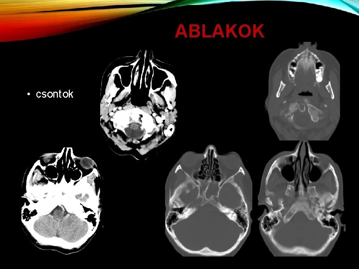 ABLAKOK • csontok 