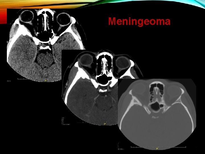 Meningeoma 