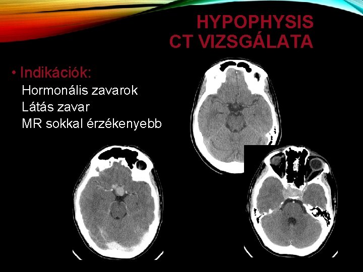 HYPOPHYSIS CT VIZSGÁLATA • Indikációk: Hormonális zavarok Látás zavar MR sokkal érzékenyebb 