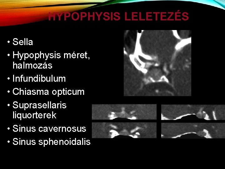 HYPOPHYSIS LELETEZÉS • Sella • Hypophysis méret, halmozás • Infundibulum • Chiasma opticum •