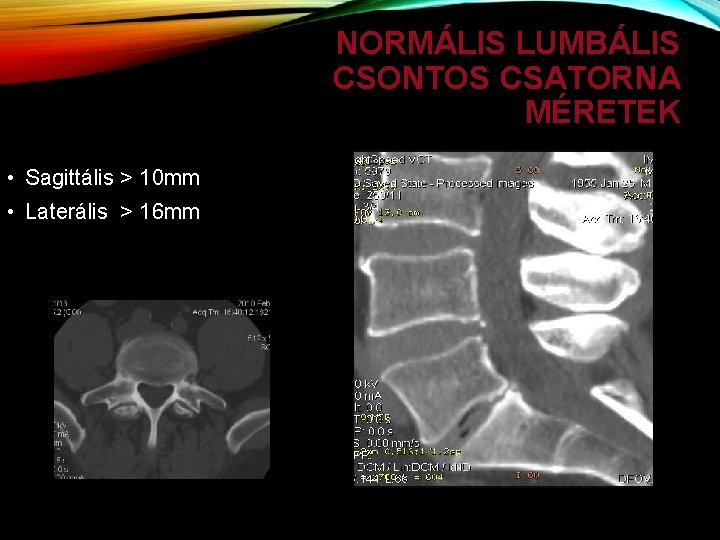 NORMÁLIS LUMBÁLIS CSONTOS CSATORNA MÉRETEK • Sagittális > 10 mm • Laterális > 16