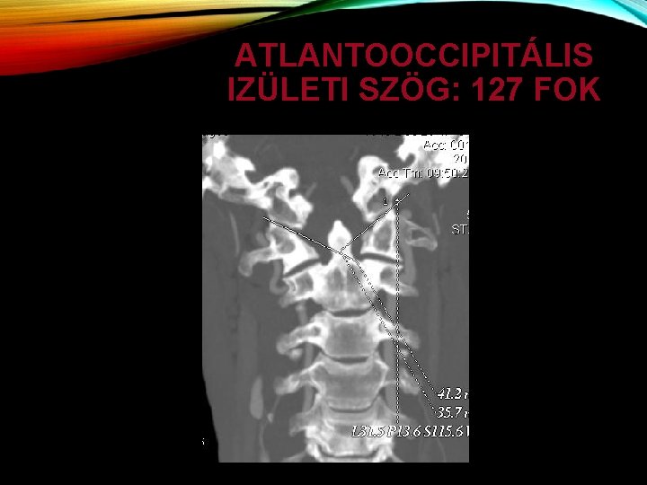 ATLANTOOCCIPITÁLIS IZÜLETI SZÖG: 127 FOK 