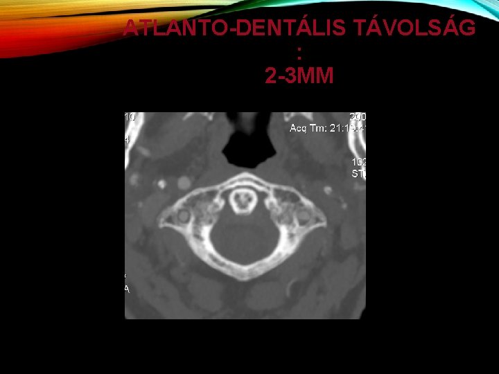 ATLANTO-DENTÁLIS TÁVOLSÁG : 2 -3 MM 