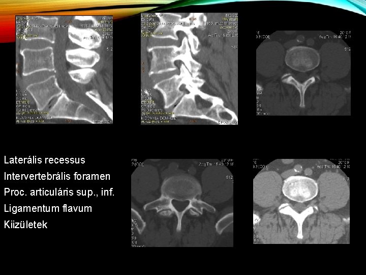 Laterális recessus Intervertebrális foramen Proc. articuláris sup. , inf. Ligamentum flavum Kiizületek 