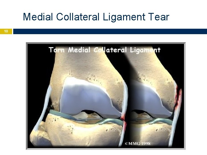 Medial Collateral Ligament Tear 10 